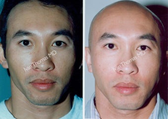 Non-Surgical Face Lift- Exoderm before 242996