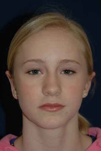 Otoplasty after 565618