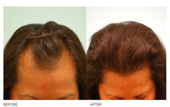 Female Hair Transplant before 133425