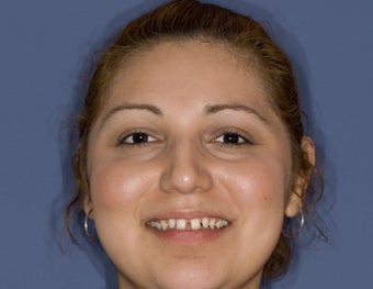 porcelain veneers before 363960