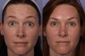 Botox to Forehead before 321253
