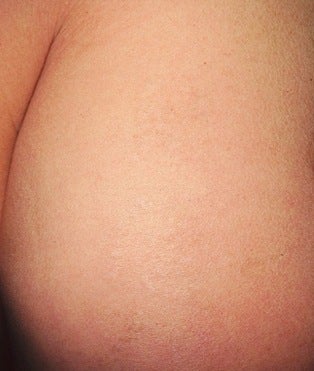 Laser tattoo removal after 374506