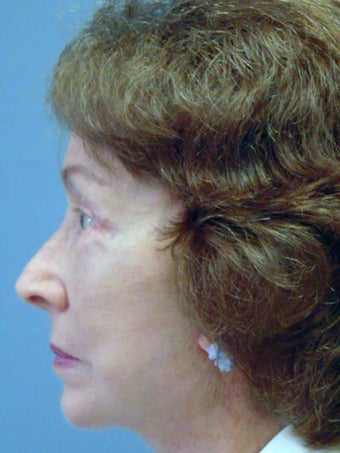 LiteLift 504610