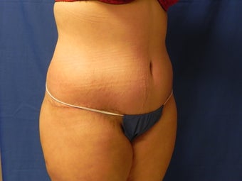 Body Lift 460718