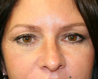 Lower eyelid blepharoplasty after 378916