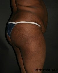 Buttock Augmentation 566726