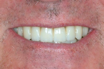 Dental implants, all porcelain restorations after 503146