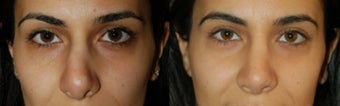 Ethnic Rhinoplasty before 346242