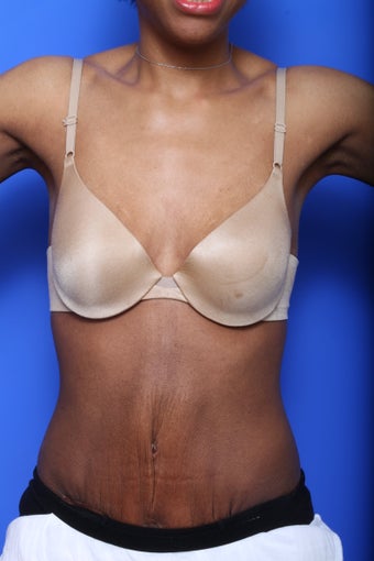 Exilis Skin Tightening before 619568