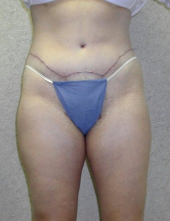 Lower Body Lift after 410338