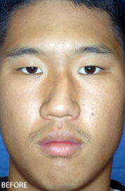 Rhinoplasty before 319071