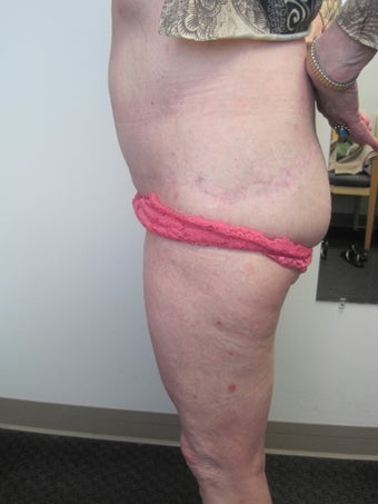 Lateral Thigh Lift after 389759