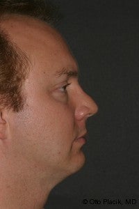 Chin Augmentation after 565878