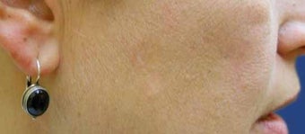 Mole Removal after 513303