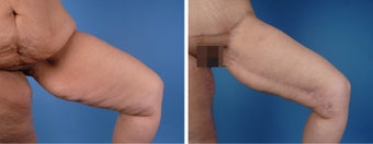 Thighplasty before 335987