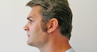 Facial Implant 494443