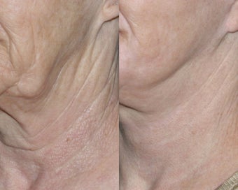 Fraxel repair for neck with C02/Erbium lasers before 104648