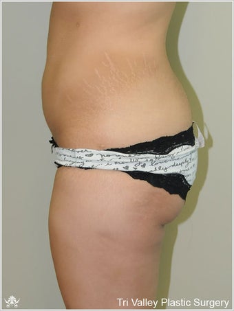Brazilian Buttock Lift before 420876