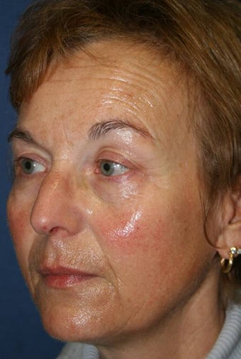 Liquid Lift before 292981