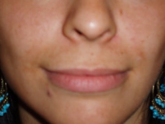 Lip Augmentations before 115574
