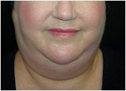 Facial/Submental Liposuction before 205376