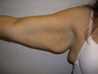 Arm Lift before 259014