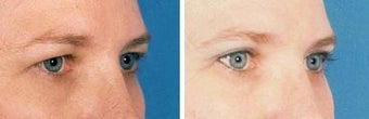 Blepharoplasty before 643212