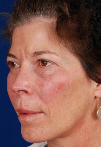 Radiesse Cheek Augmentation after 263002