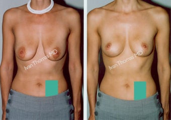 Mastopexy-Breast Lift before 243701