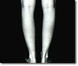 Calf Implant 566015