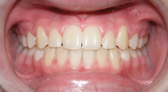 Teen Orthodontic Treatment (case #1AD) after 224689