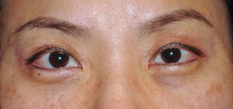Upper Blepharoplasty after 365448