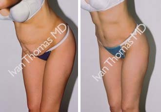 Tummy Tuck before 242528
