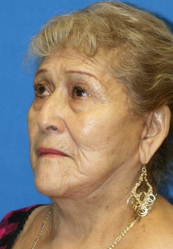 Face lift, after 263978