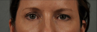 Ultherapy before 541293