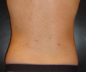 Smartlipo PRO-Sculpt after 560436