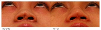 Asian Rhinoplasty after 136818