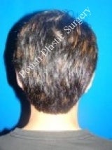 Ear Surgery (Otoplasty) after 584554