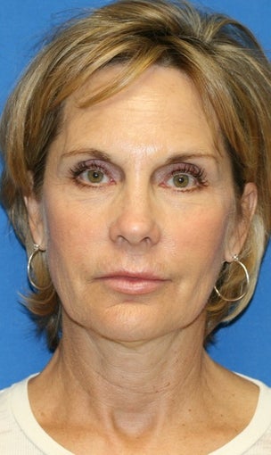 face Lift before 367610