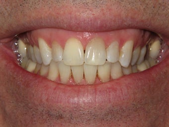 Whitening with walking bleach after 293325