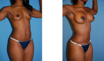 Tummy tuck, breast lift, breast implants, liposuction before 307046