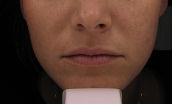 Belotero in the Lips before 581291