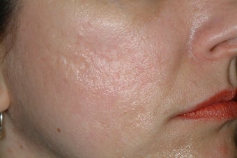 Fraxel Laser before 86802