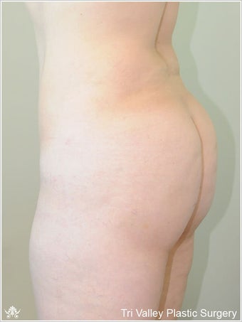 Brazilian buttock lift after 420868