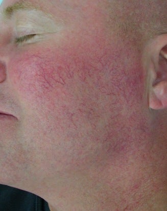 Facial Vein Treatment before 374356