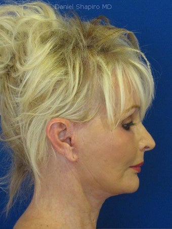 Cheeklift (minifacelift) with TCA chemical peel to the lower eyelids performed in the office under oral sedation with local anes after 249173