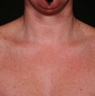 IPL for Chest after 374389