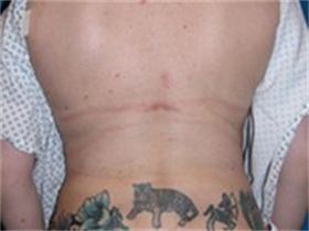 Liposuction after 631026