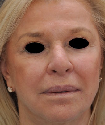 TCA Full-Face Chemical Peel after 182428