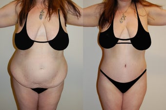 Body Lift & Brazilian Butt Lift before 574698
